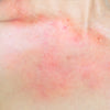 Can Dancewear Cause Skin Irritation?
